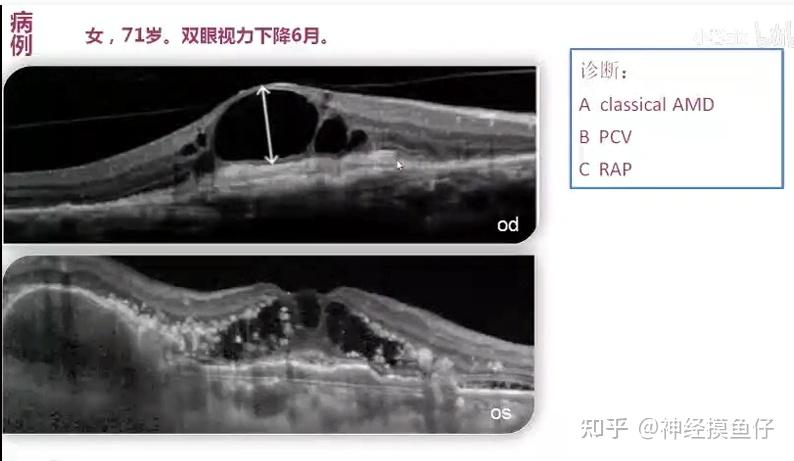学习笔记|OCT所见与所思--丁小燕教授 - 知乎