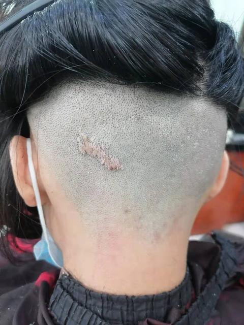 吃柠檬不酸疣状痣治疗与切除等待回答精华讨论67管理67日志暂无