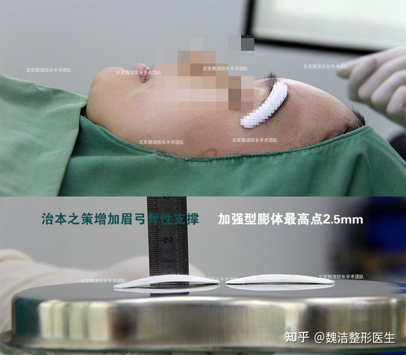 3mm厚度的假体丰眉弓 女性垫眉弓属于修饰美 杜绝生硬男相化是关键 - 知乎