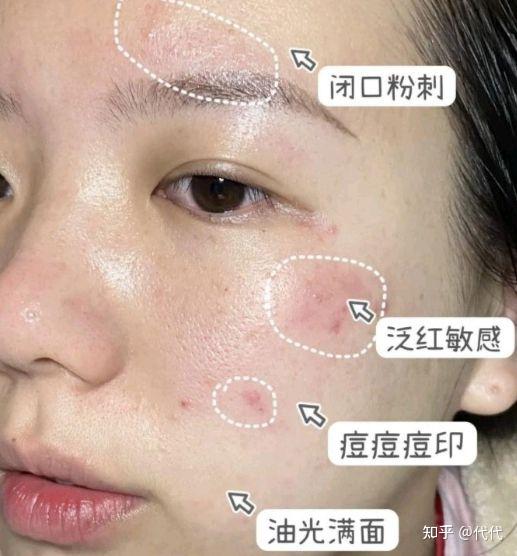 华巾大的草本护肤之道！油敏肌的自救指南|华巾大龙胆水乳对大红脸say NO！！ - 知乎