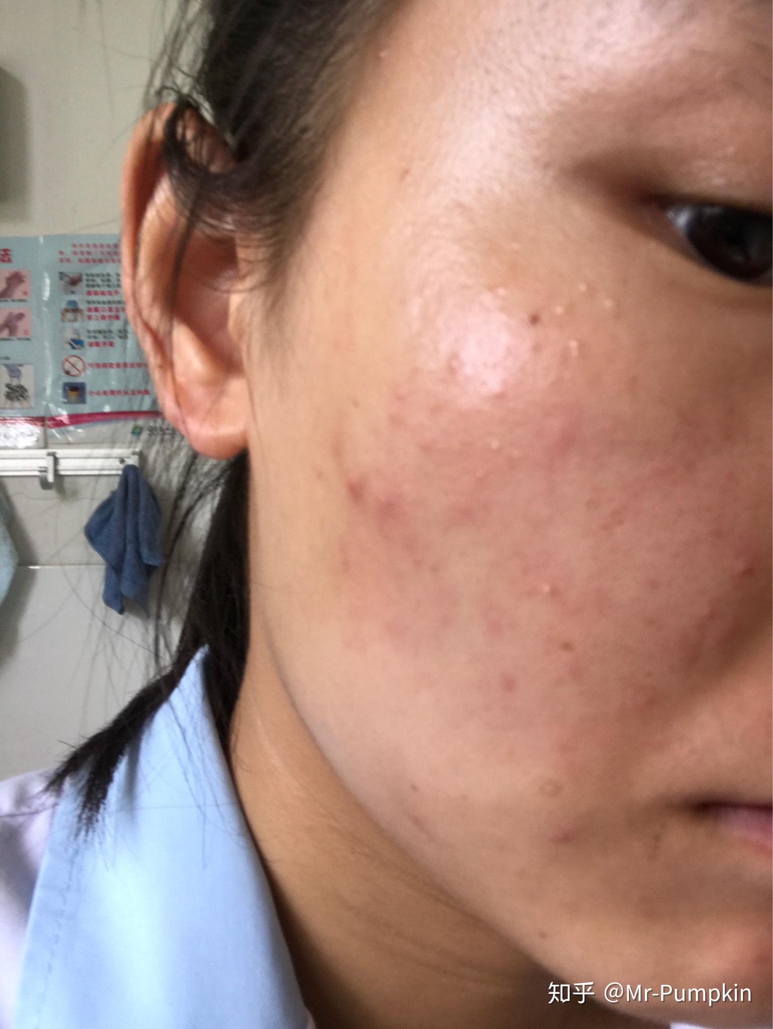 请问有小仙女用雅诗兰黛沁水过敏吗? - 知乎