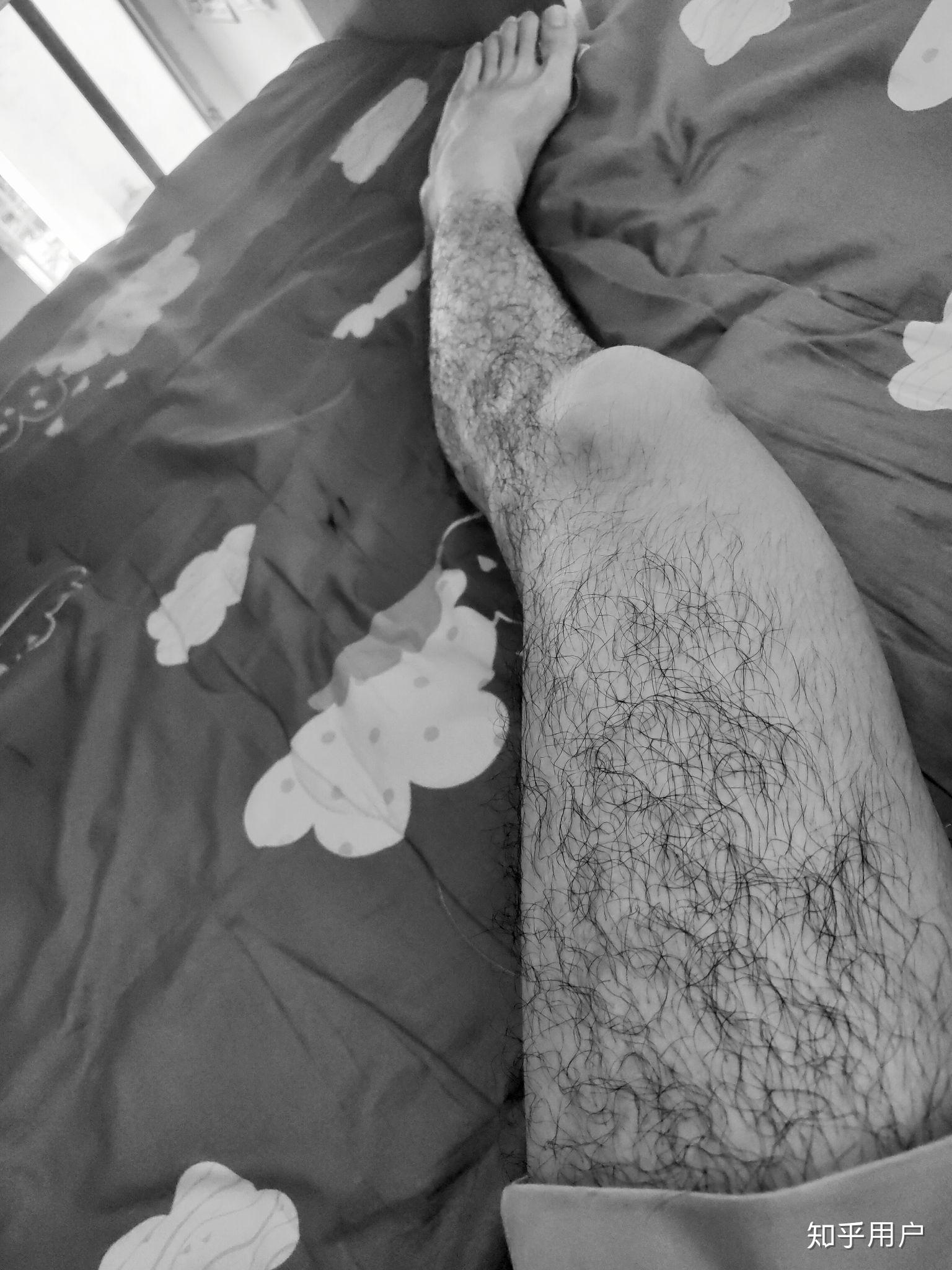 男生腿毛浓密怎么办