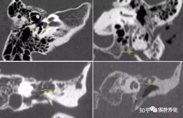 常见异常的颞骨CT总结 - 知乎