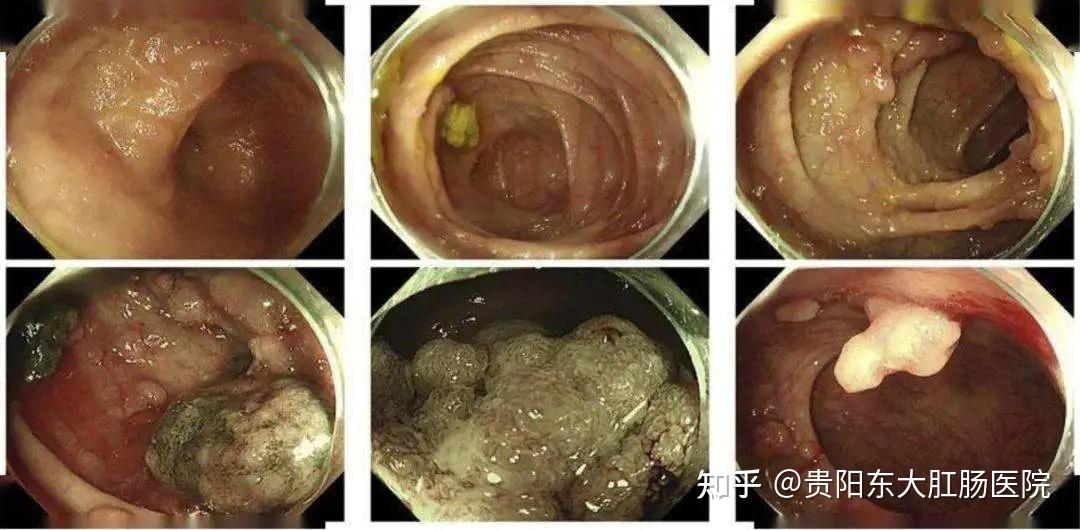 胃息肉切除后一年复查没增生那需要几年再复查