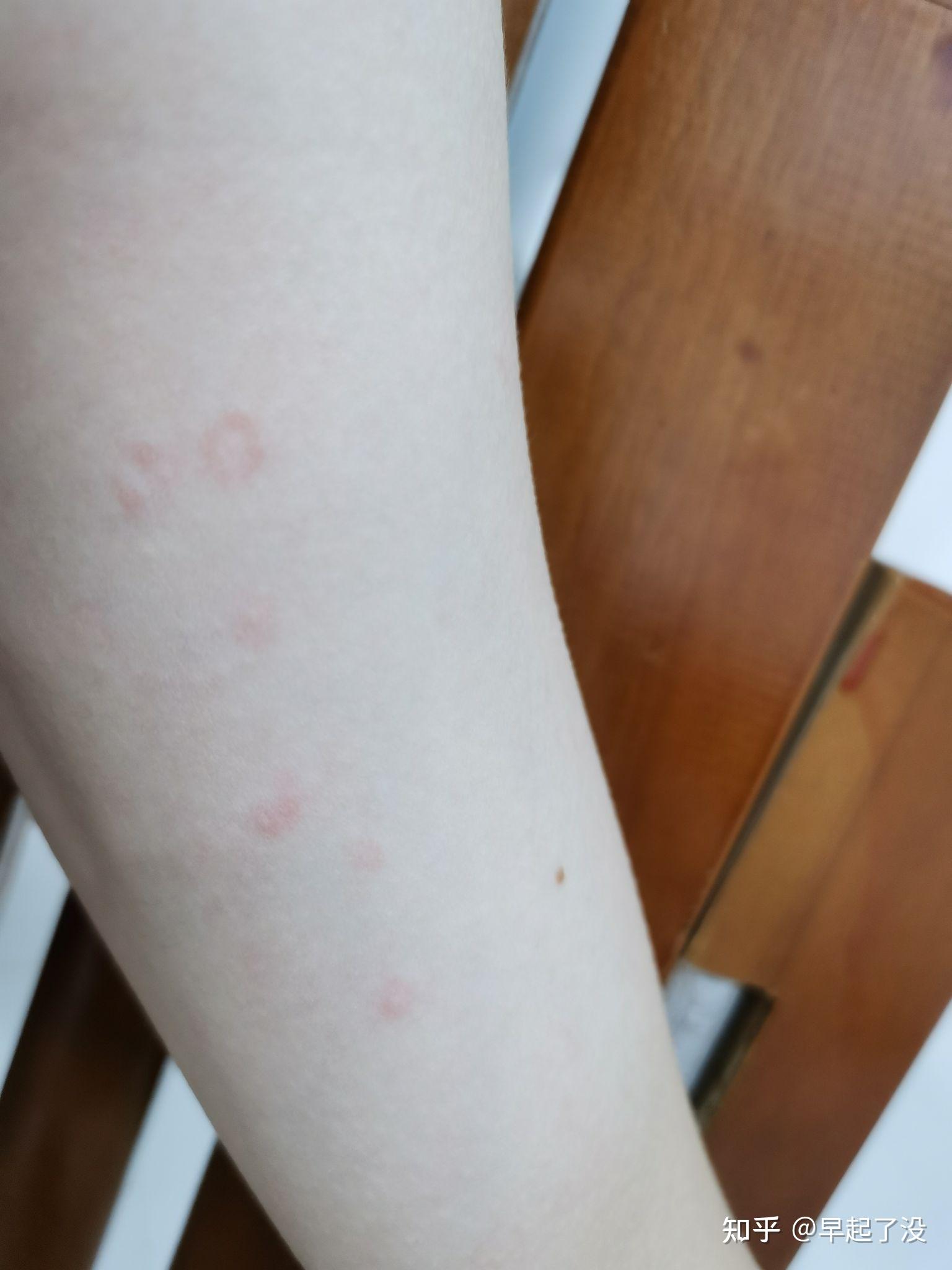 荨麻疹血管炎是很严重的病吗有得同样病的人吗