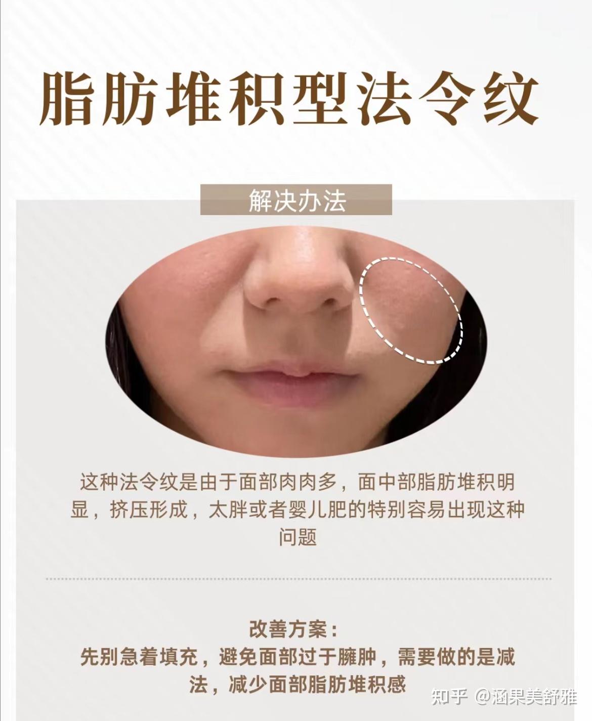 怎样改善法令纹? - 知乎