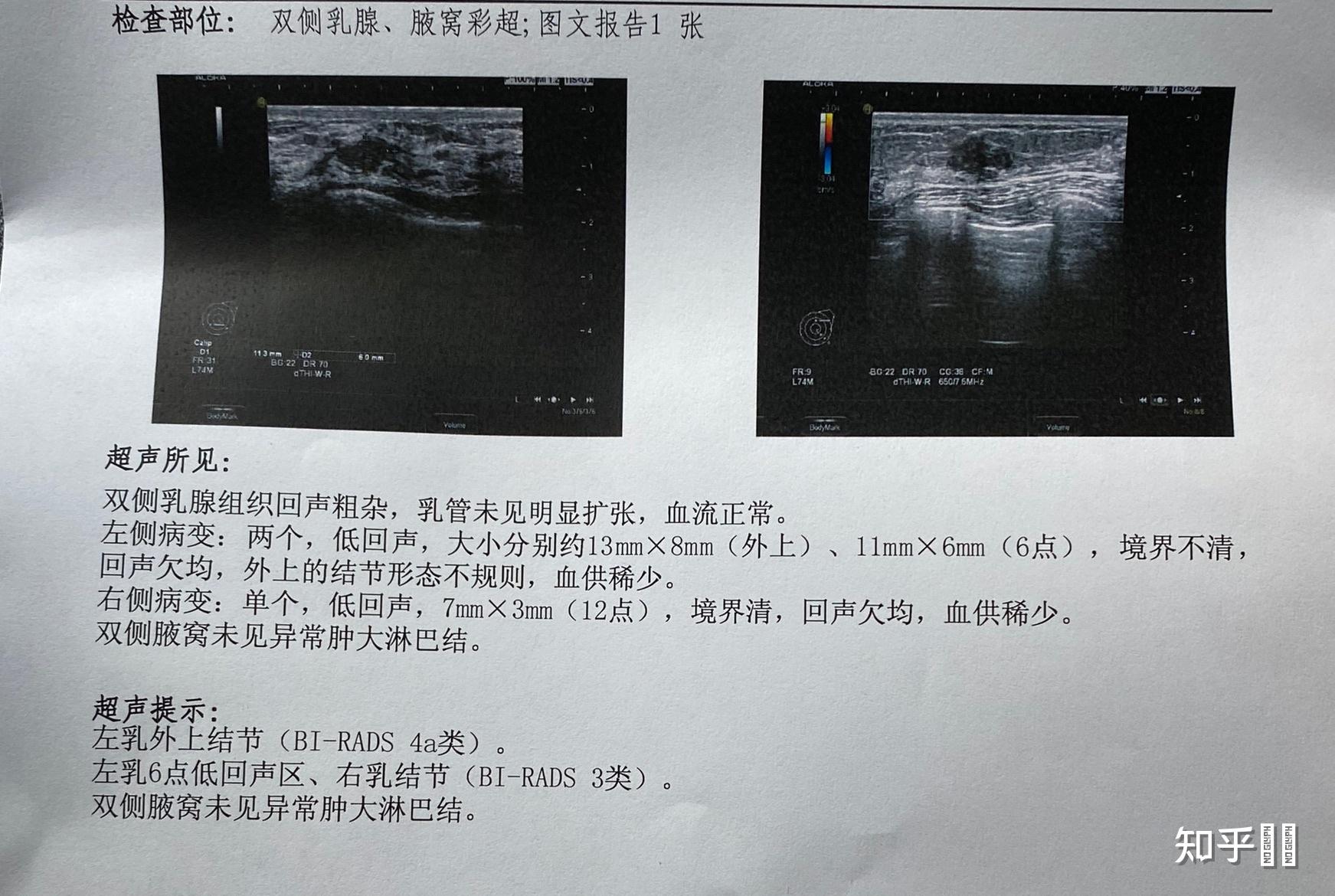 乳腺超聲檢查報告birads3級的女人們你們幾歲發現的目前是良性的還是