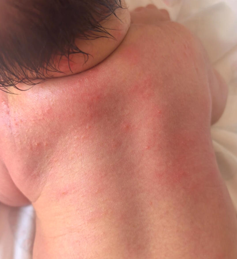 停掉“传统”痱子粉,宝宝痱子反而好了?复盘20天:搞懂婴儿“散热逻辑”,做对清洁与隔离才是去痱关键! - 知乎
