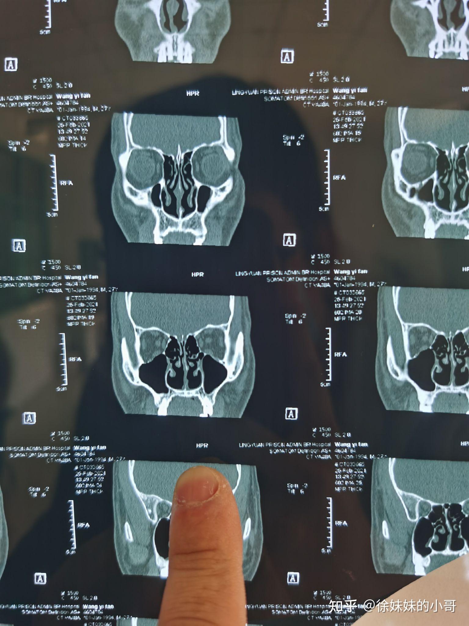 有没有近期做过鼻中隔偏曲以及下鼻甲肥手术的朋友?分享一下 ?
