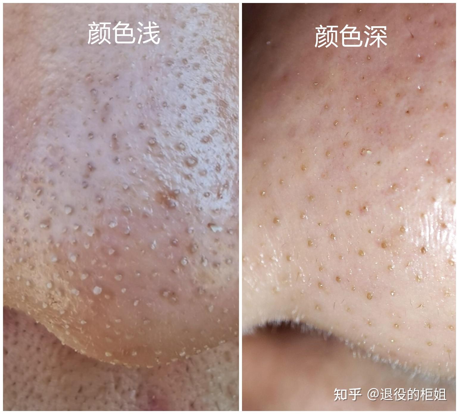 这是毳毛还是黑头？求求解答，有什么方法去除吗? - 知乎