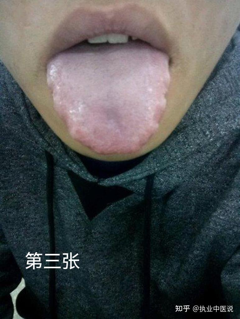中医舌诊：脾虚湿盛、阴虚内热和脾肾阳虚的舌苔是什么样的？ - 知乎