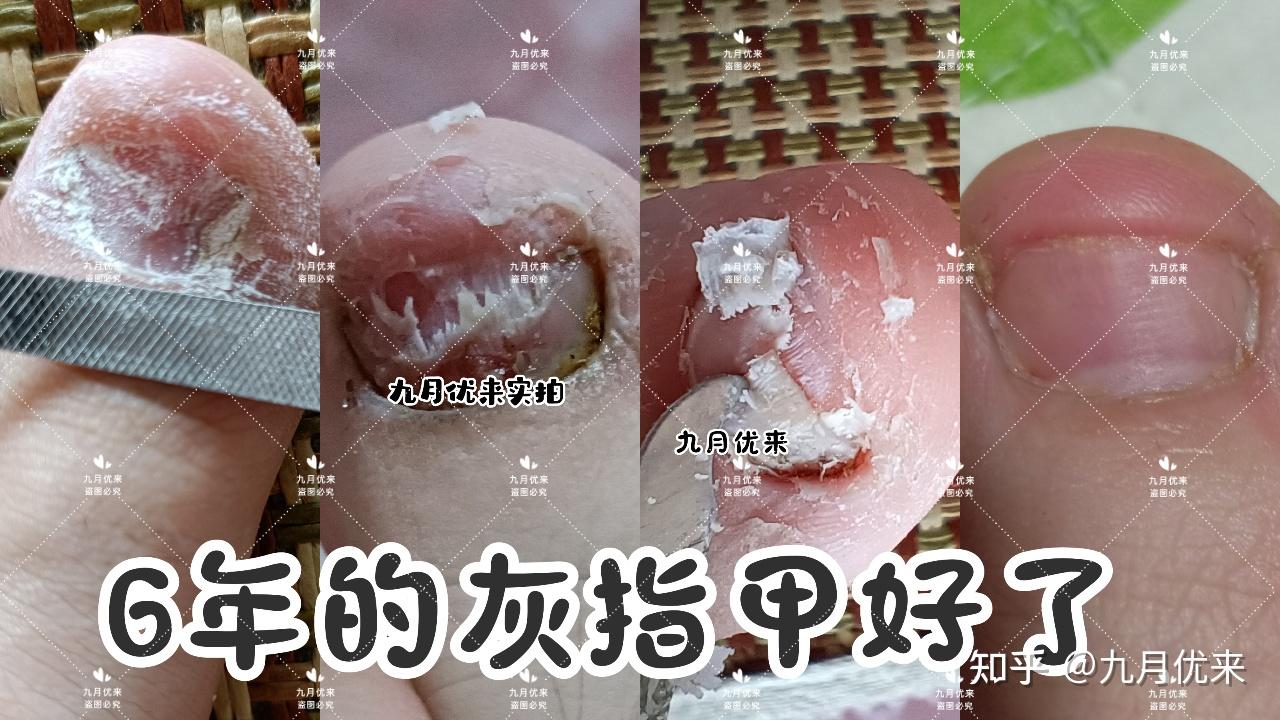患上灰指甲,如何无痛脱甲?1个方案10天左右褪去病甲,然后去除甲床下的真菌,灰指甲才能上岸!