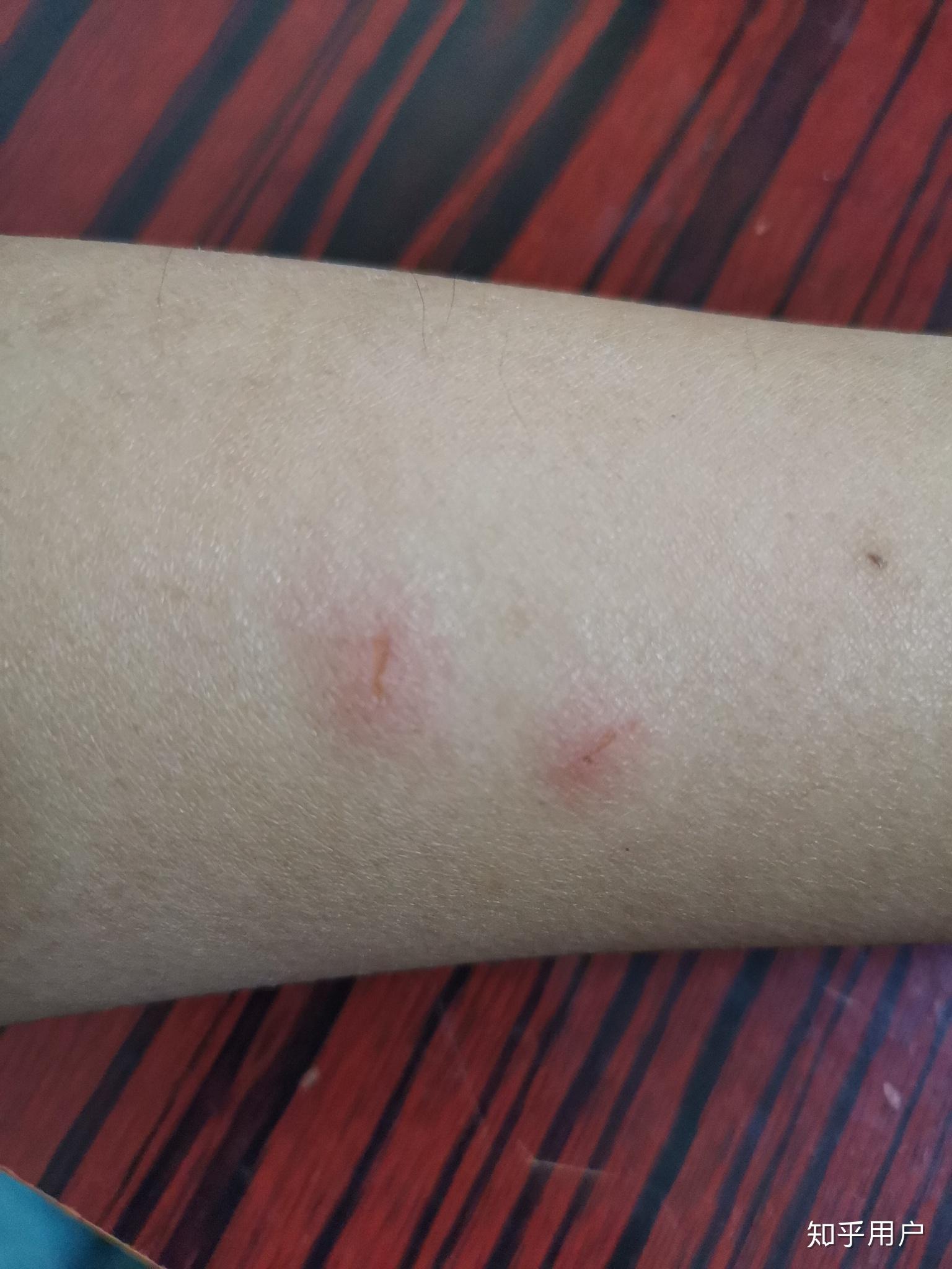 刚刚被猫抓伤了出了一点血大概是表皮的我刚刚舔了一下伤口用不用打