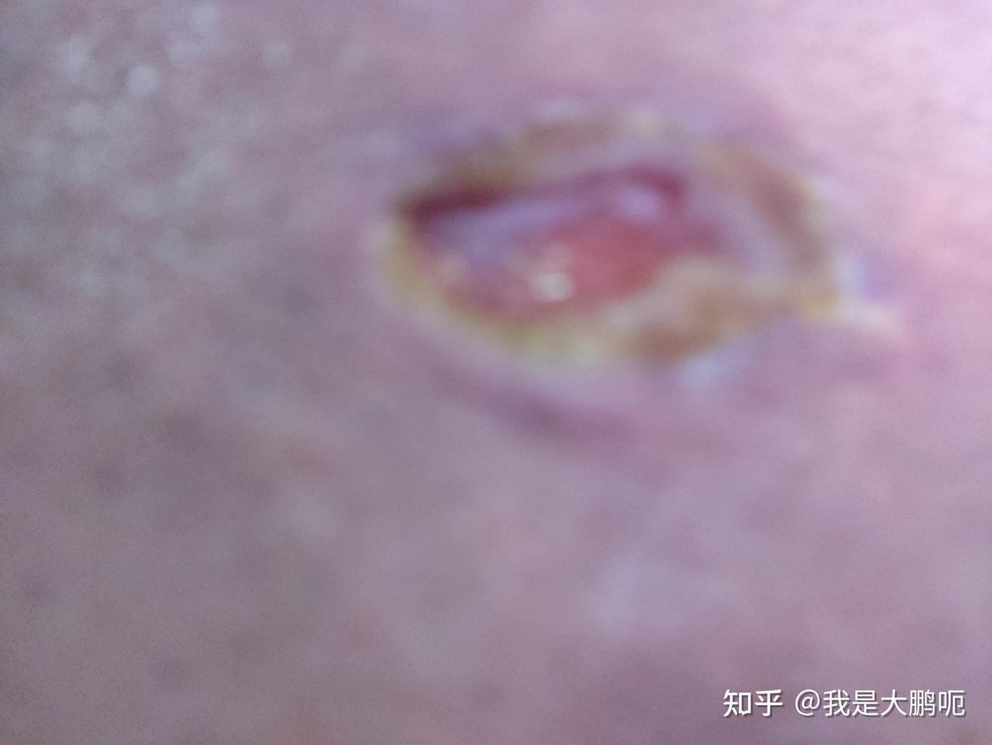 分享下个人疖肿痈肿的治疗之路 - 知乎
