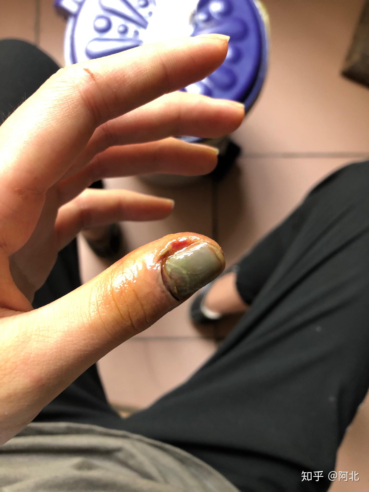 手指被门夹肿还夹出淤血是什么感受? - 知乎