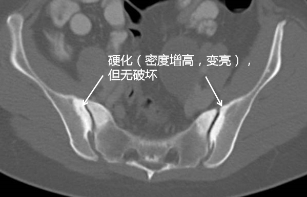 双侧髂骨致密性骨炎有没有好的办法治疗? - 知乎