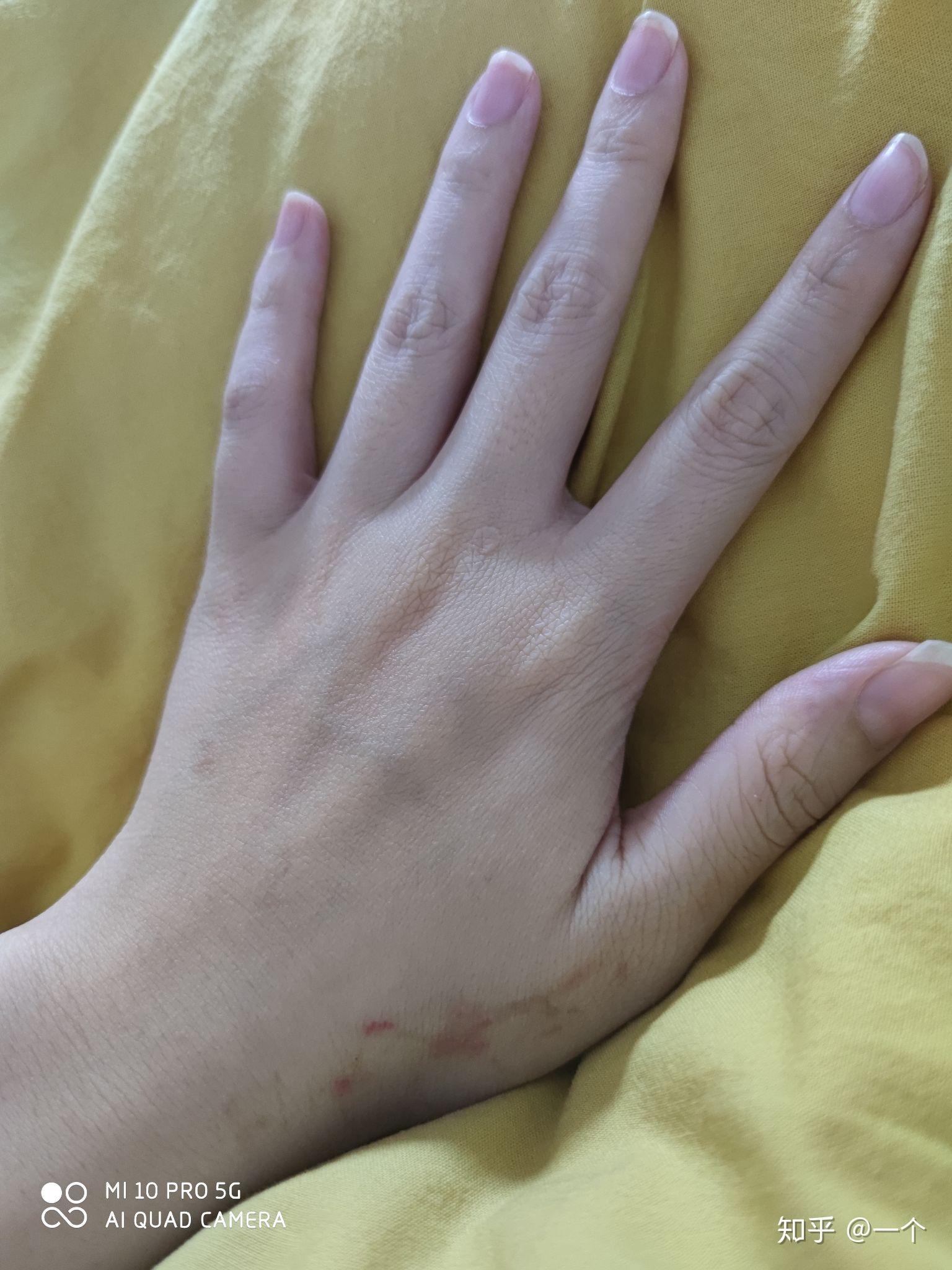 年纪轻轻23岁手上皮肤就很干有很多皱纹像老年人干瘪的手怎么办呀