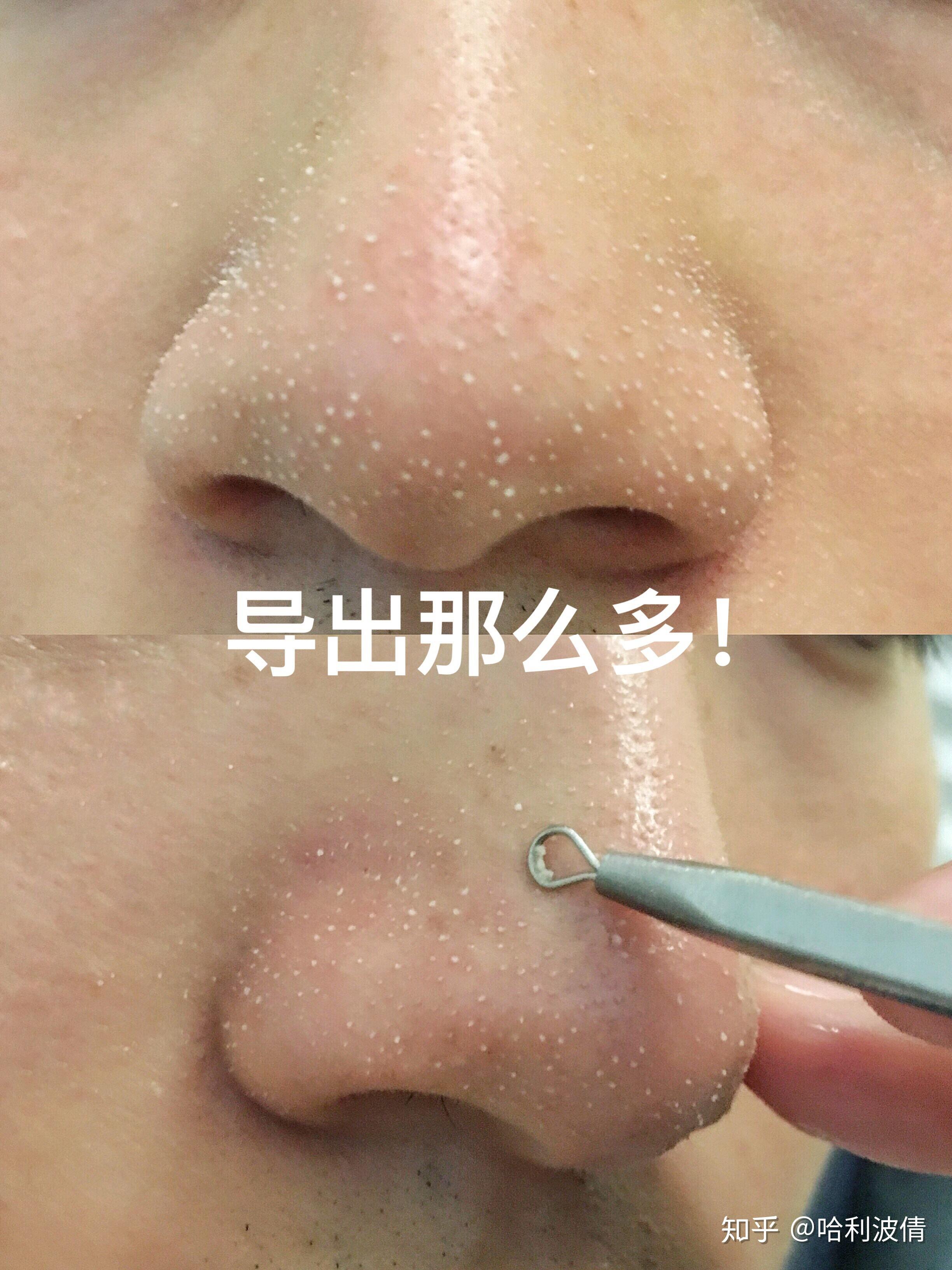 如何去除鼻子上的黑头?