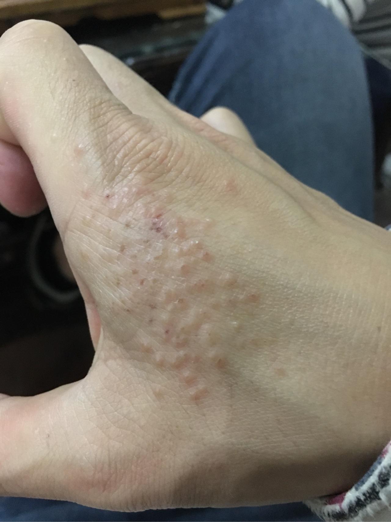 医生说接触性皮炎? - 知乎