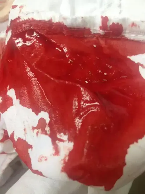 肚脐中弹有什么感觉