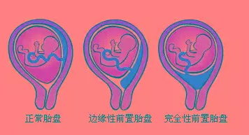 连接母婴生命线的胎盘异常,对母体和胎儿有什么影响? - 知乎