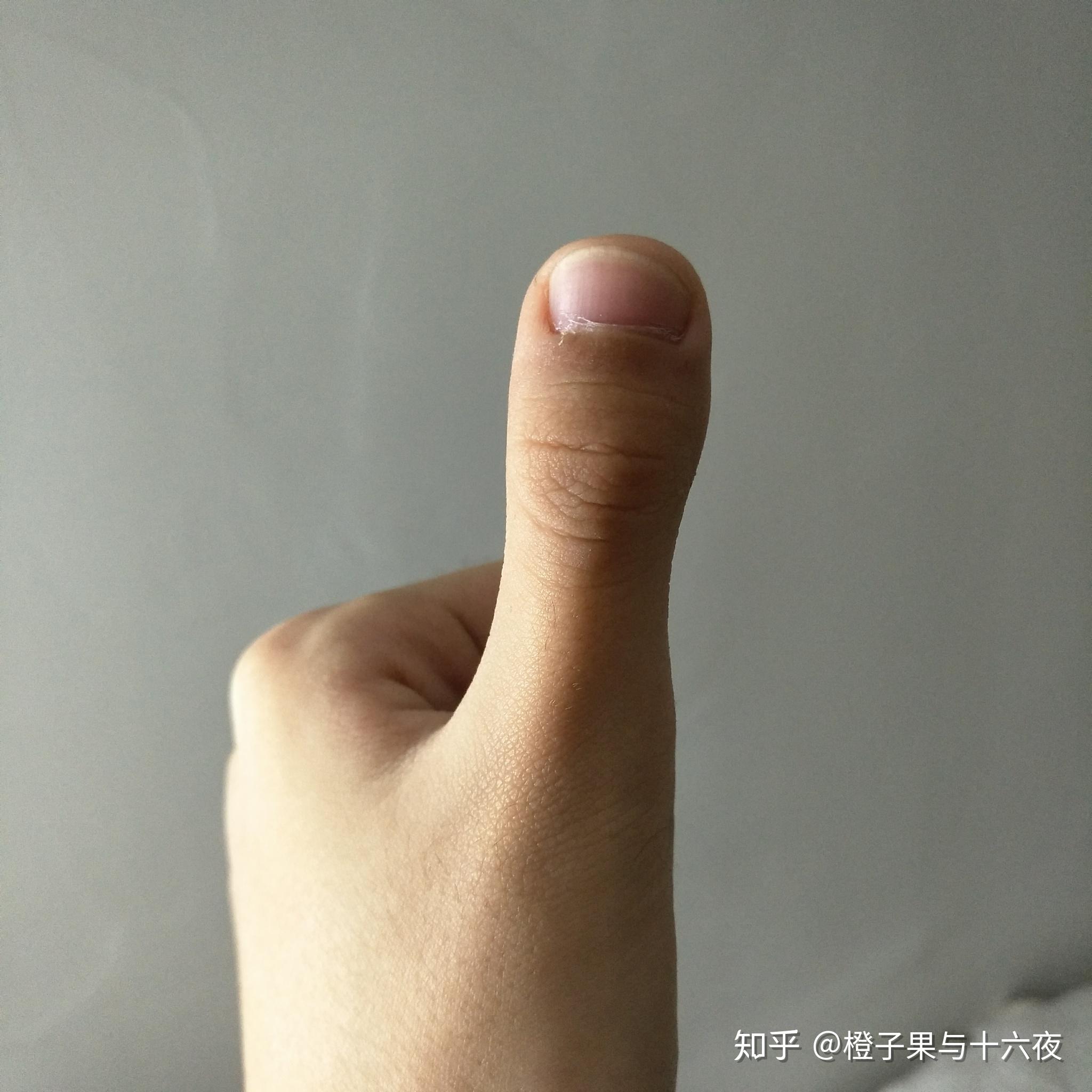 大拇指扁平特别宽图片