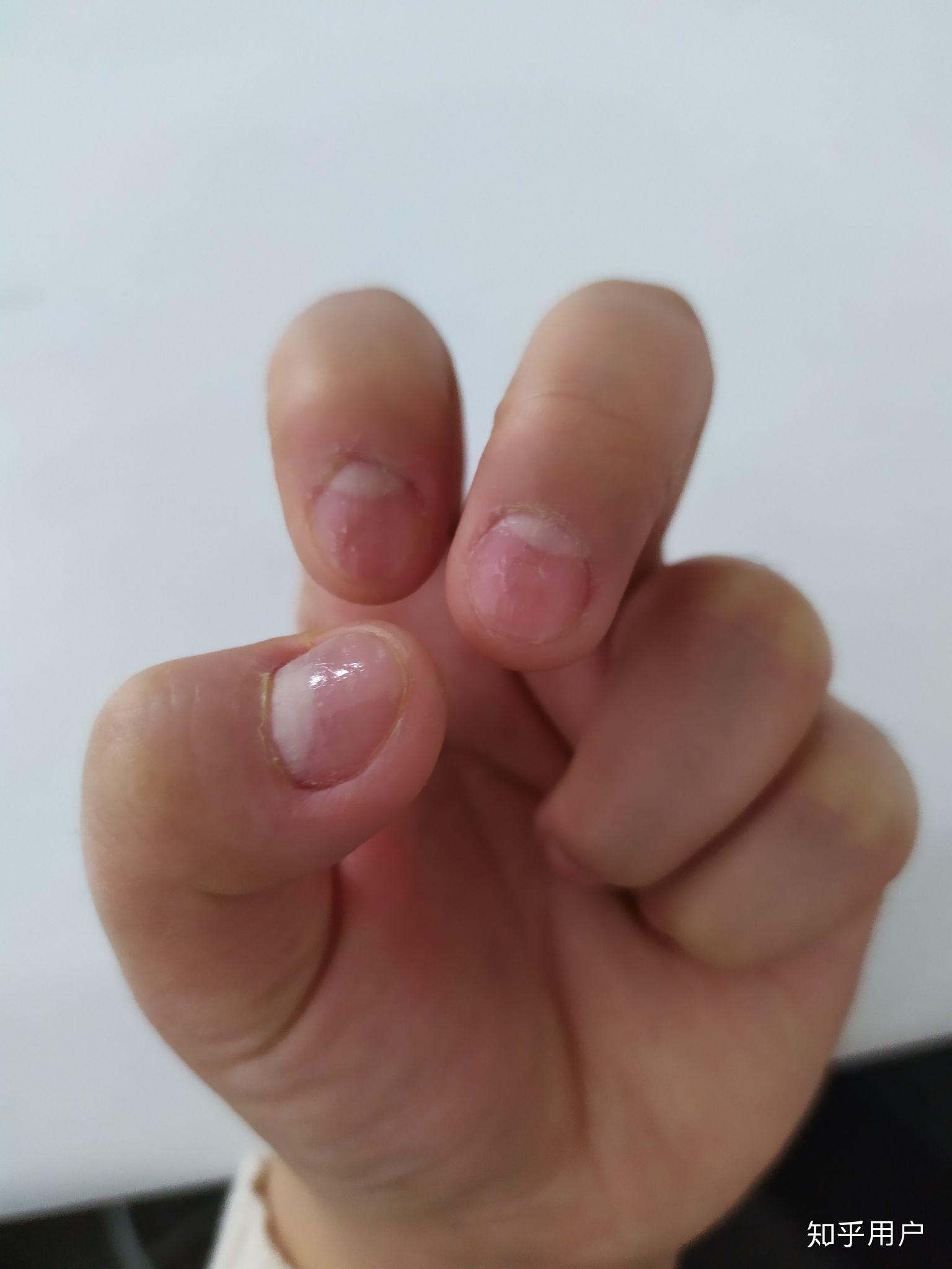 克制不住的抠手指头是心理问题吗