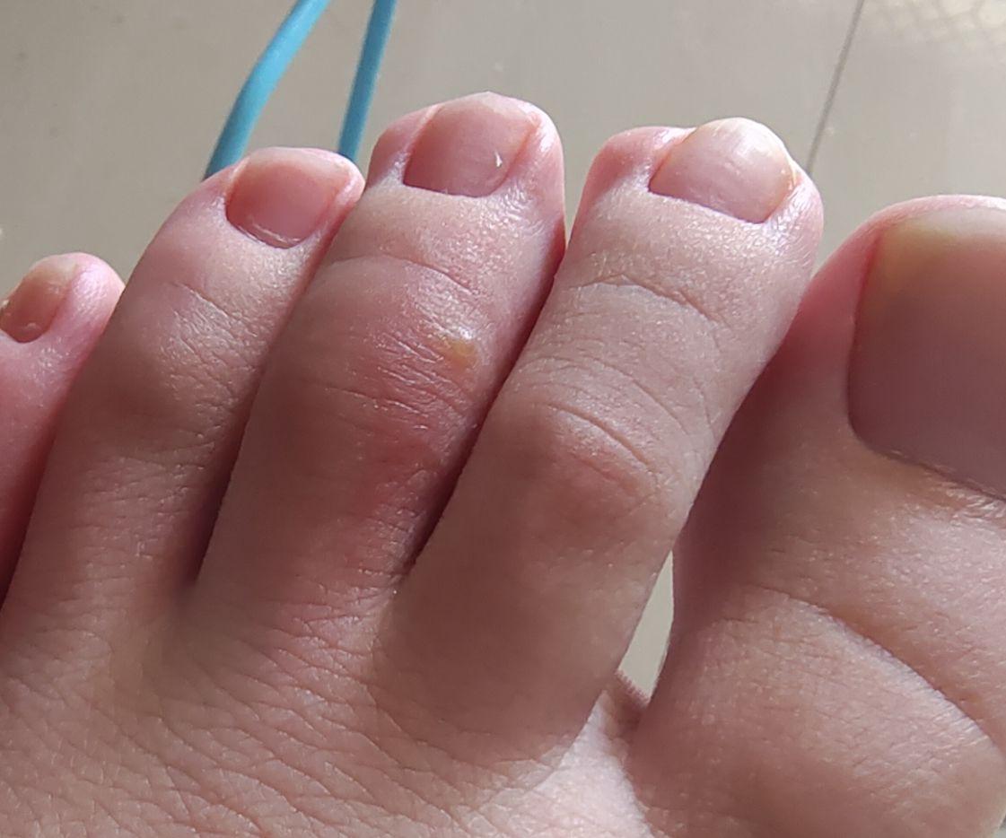 被蚂蚁咬之后用药什么更有效呢? - 知乎