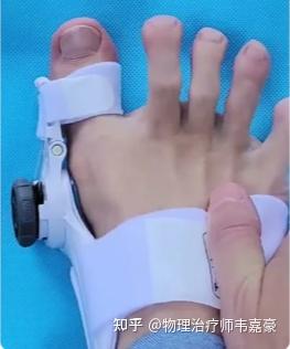 拇外翻(拇囊炎)物理治疗指南 - 知乎