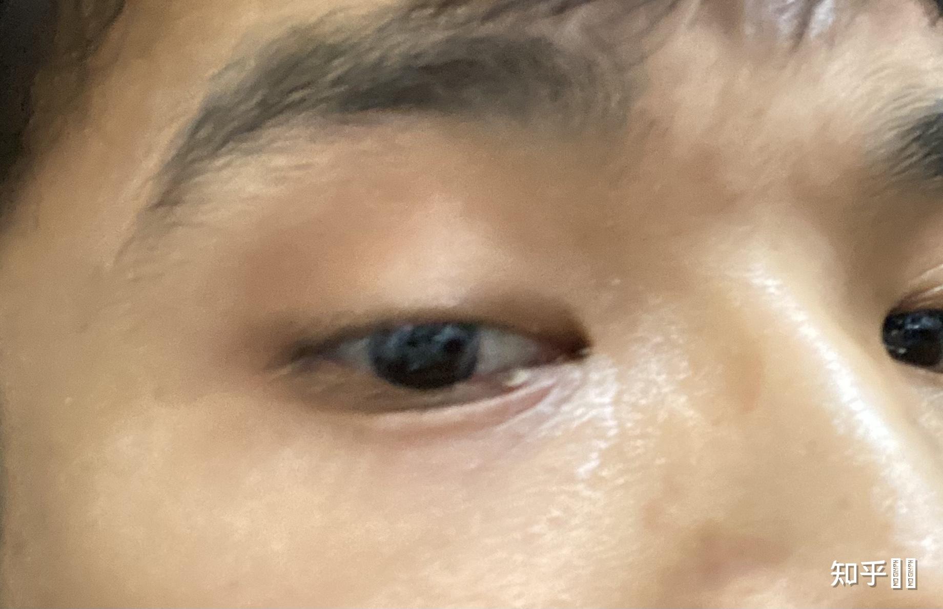 生了撅眼怎么办? - 知乎