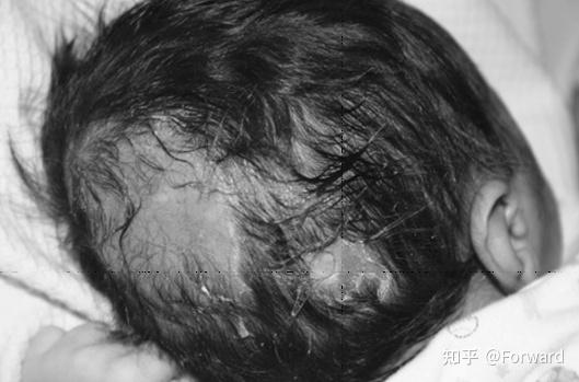 小婴儿枕秃就是缺钙了吗? - 知乎