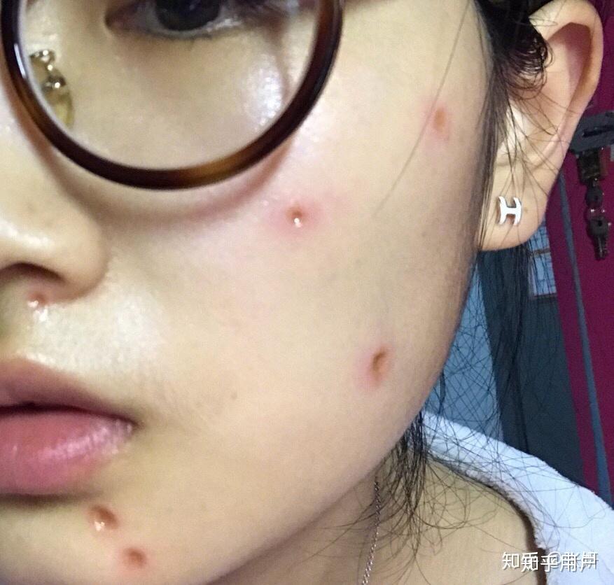 点痣成功与否会受季节影响吗