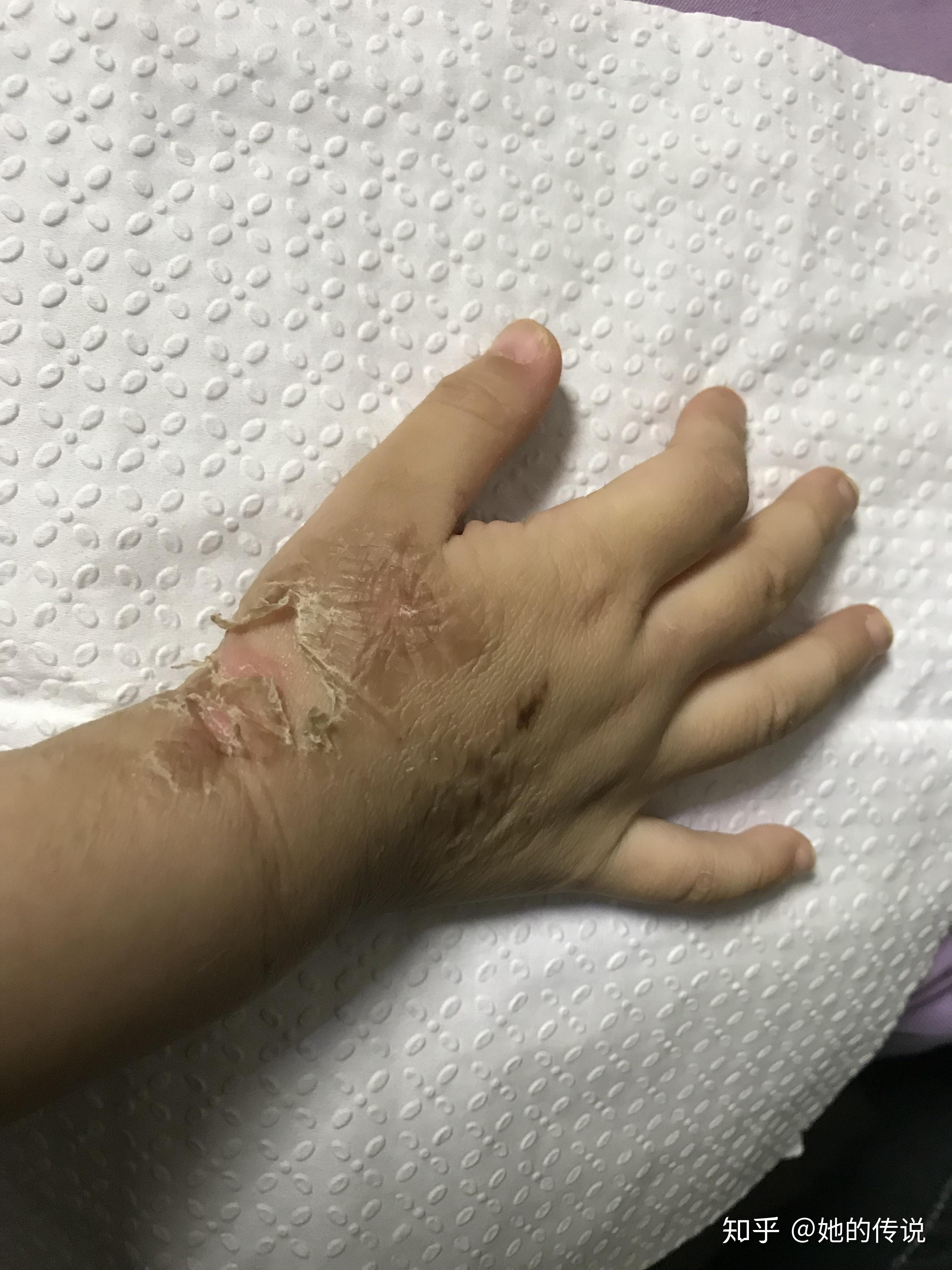 被隐翅虫咬了怎么治?让他自己好?还是要看医生? - 知乎
