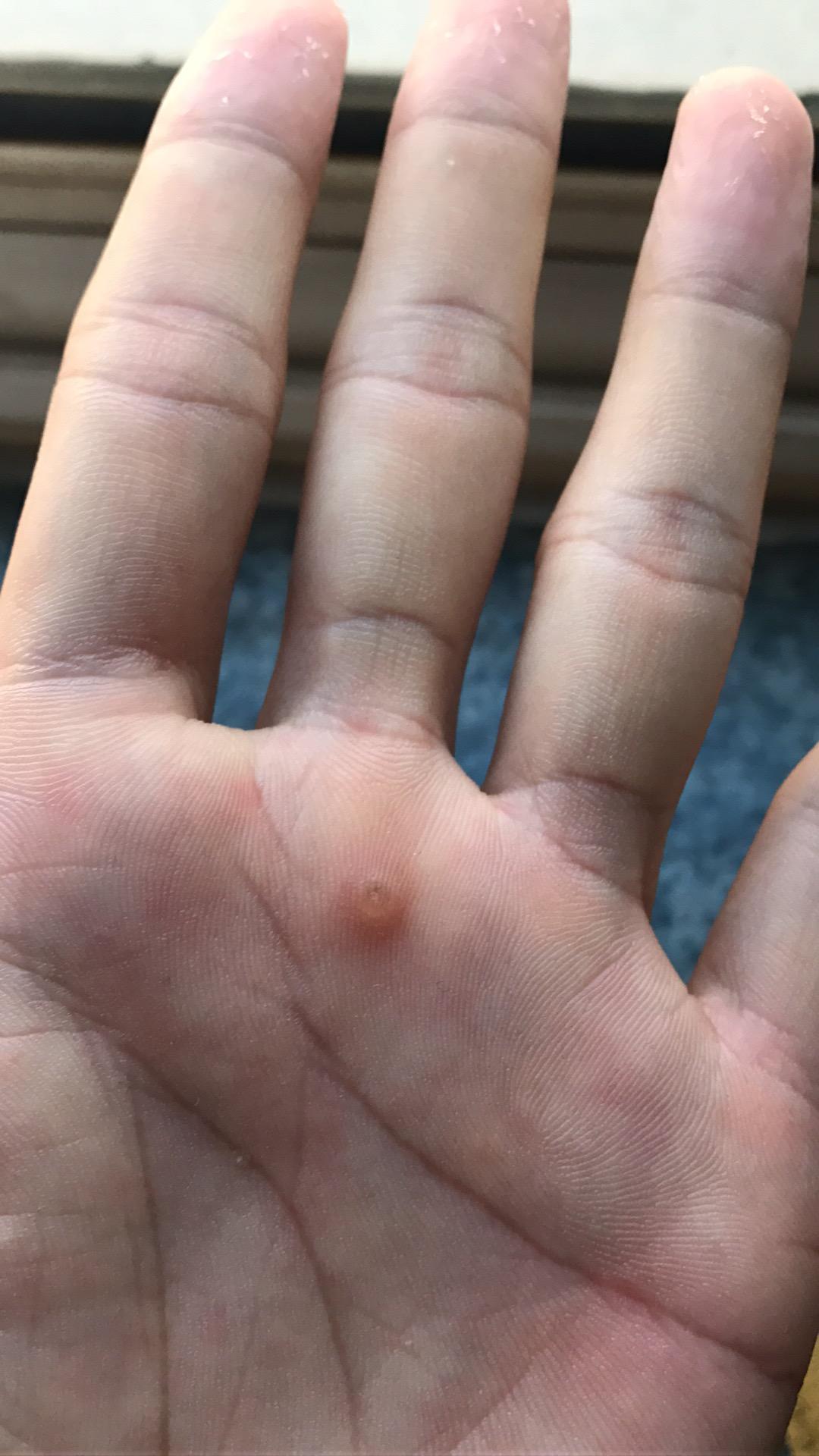 手掌上长了一个小疙瘩