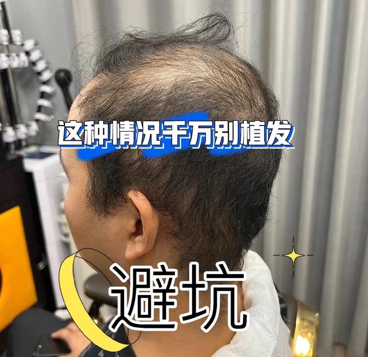 植发避坑指南！植发过程中哪些信息值得被关注？做植发手术如何才能不踩坑？靠谱的植发医院医生怎么选？ - 知乎