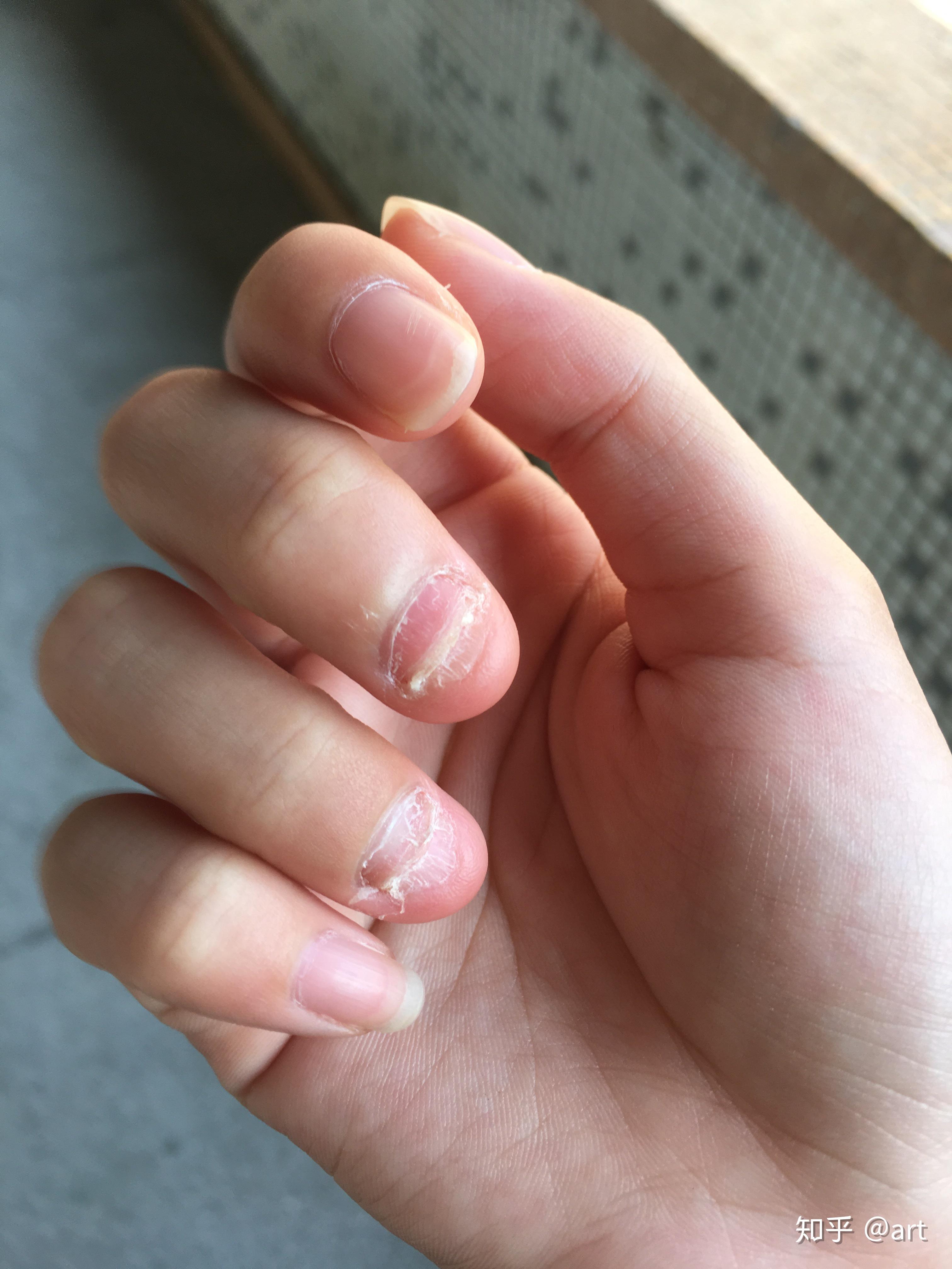 一个人喜欢不自觉的啃手指甲反映了什么潜在的生理心理特征