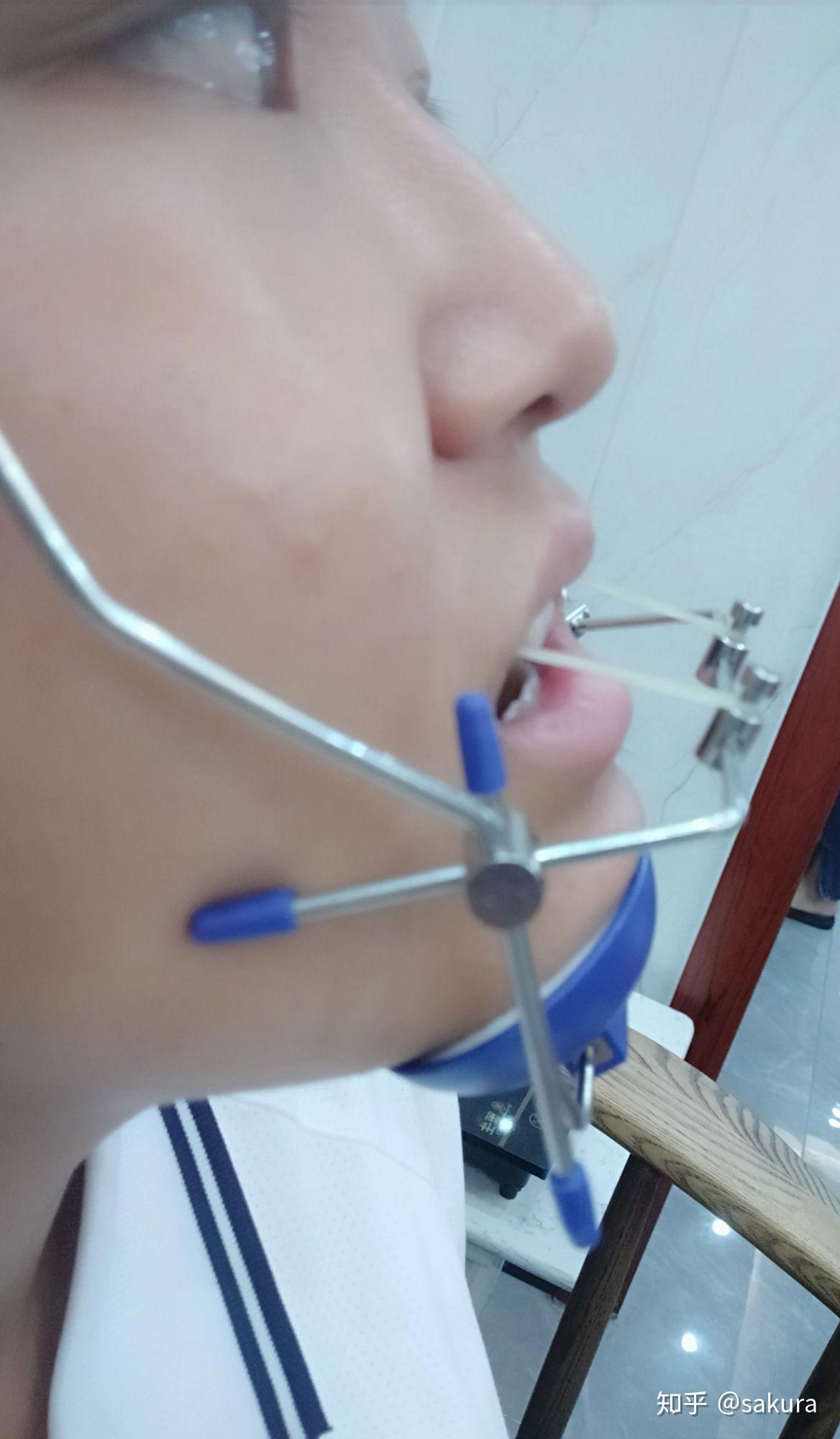 有没有治疗反颌(地包天)戴过矫治器 面框的人呀? - 知乎