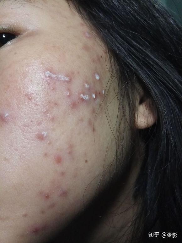 额头,下巴,脸颊都长了好多白头粉刺!求治疗方法~?