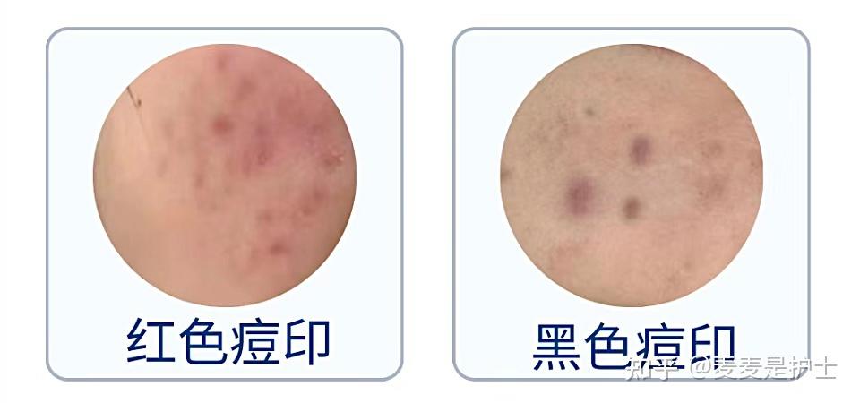 【中科院博士】教你如何去红黑痘印！这款美白精华既能修护还能美白，一个月就能拥有无暇嫩白肌肤！赶紧收藏！