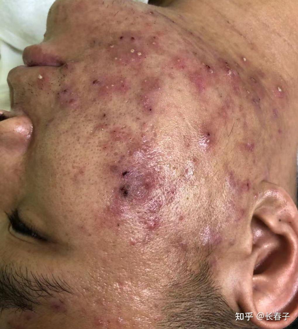 囊肿型痘痘怎么消下去