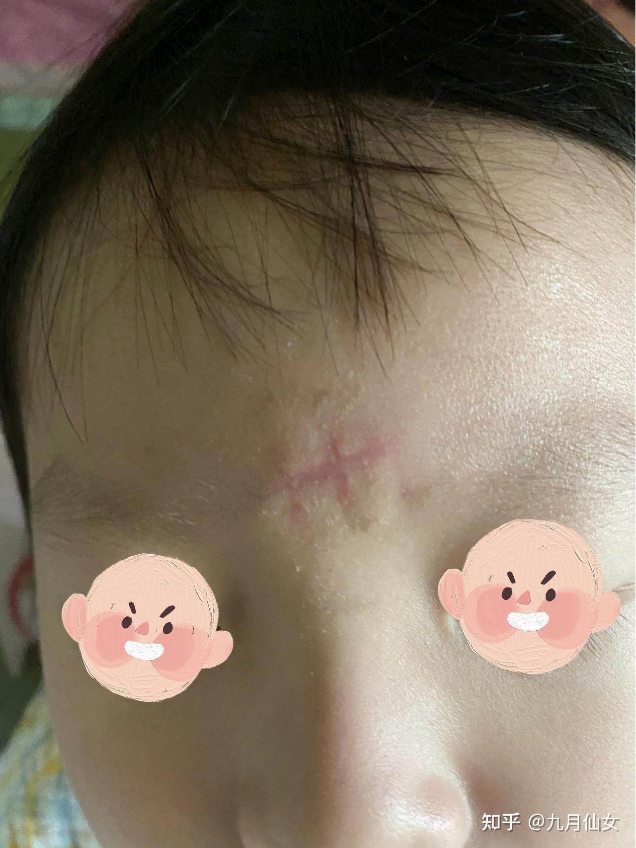 宝宝缝针疤痕怎么办？ - 知乎