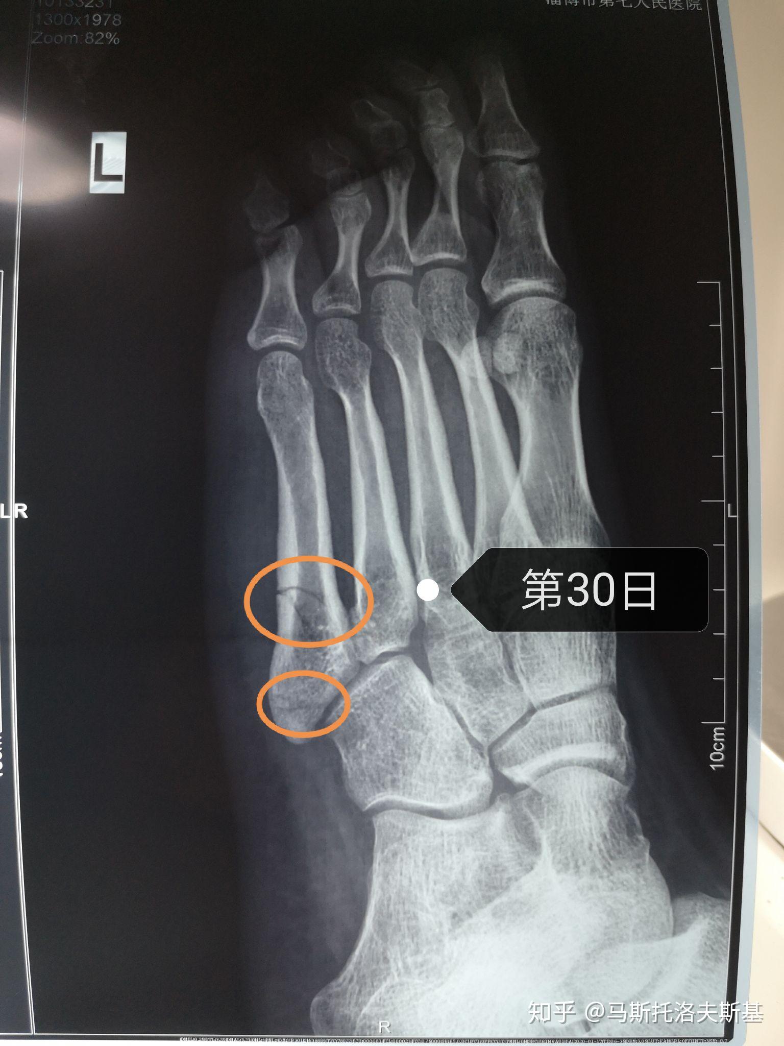 左脚第五跖骨骨折