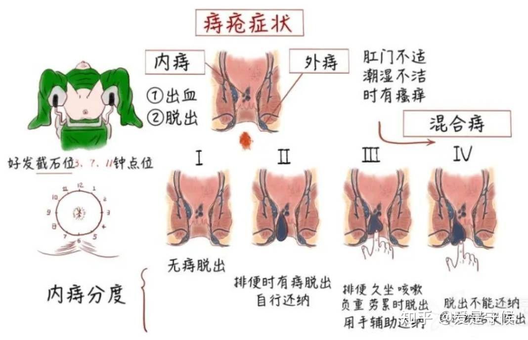 怎么判断自己是否得了痔疮