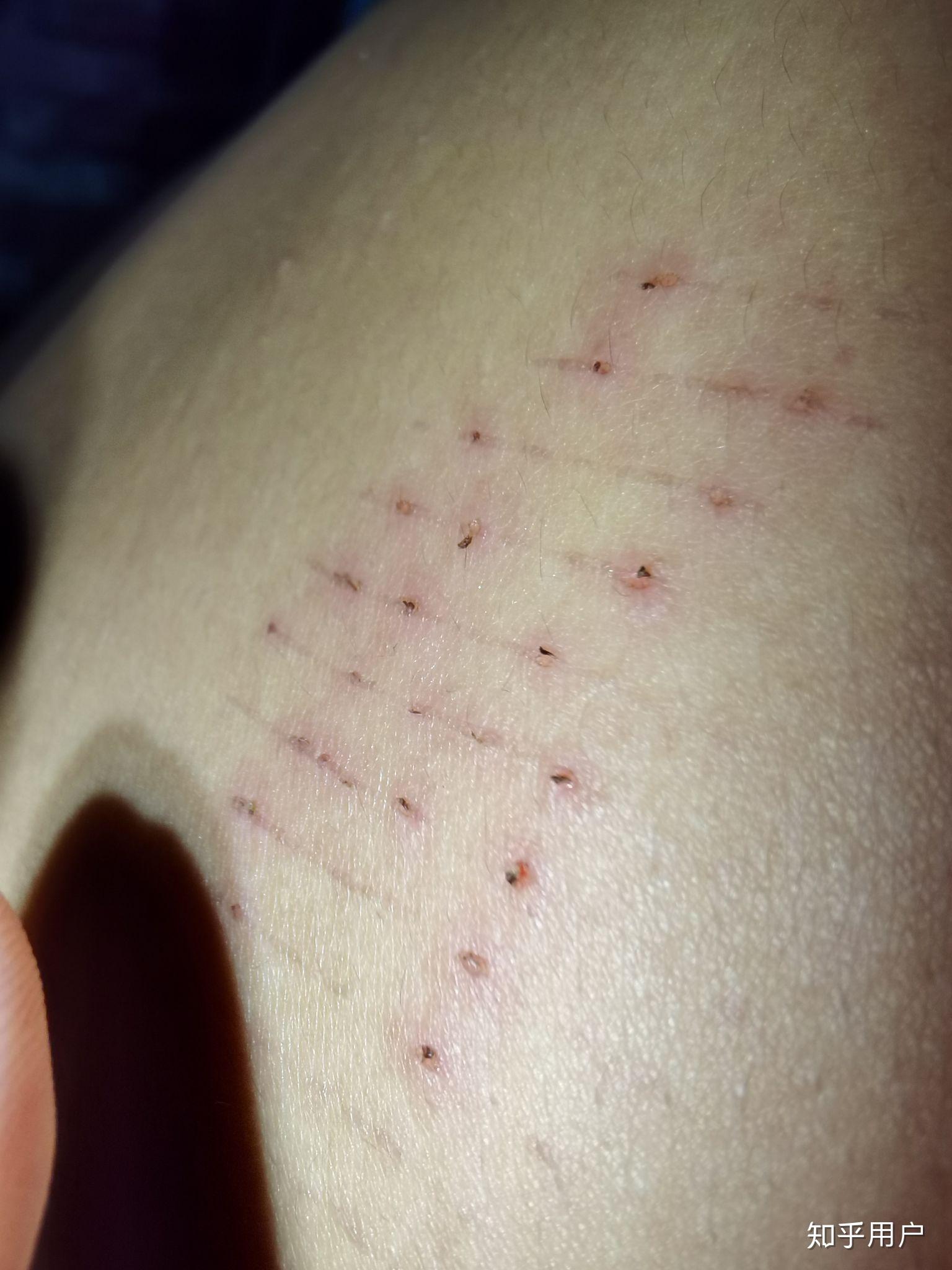 今天身上再次出现莫名划痕,求解? - 知乎
