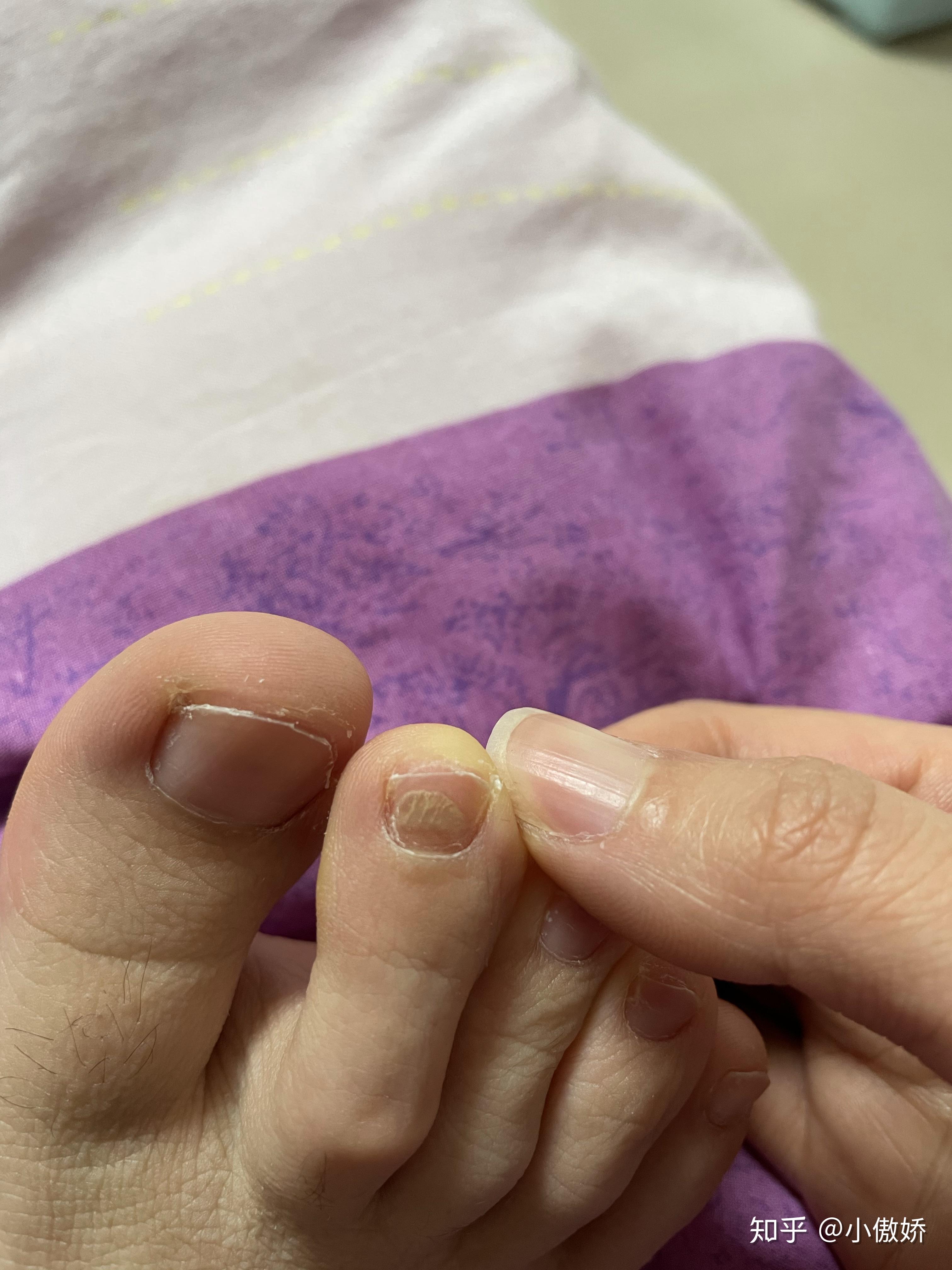 有人知道灰指甲吗,有照片,帮忙看一下?谢谢各位大神 - 知乎