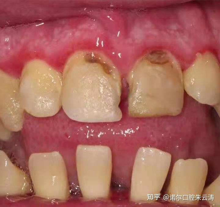 洗牙后让牙结石占据的空间可能让牙龈再长回去充满吗? - 知乎