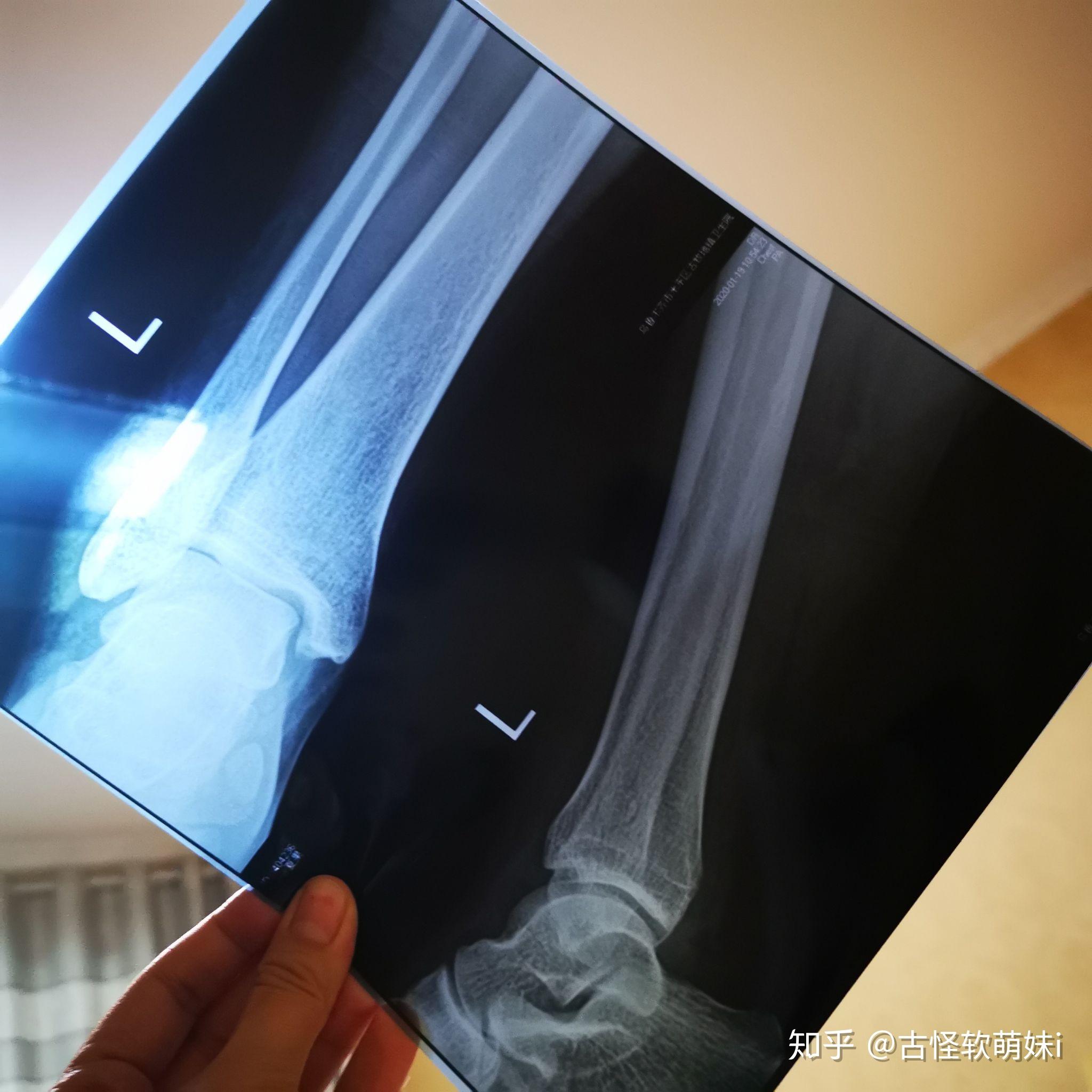 外踝骨折多久拆石膏?