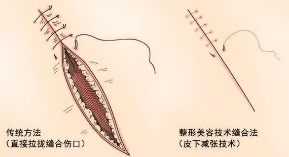 根部袖套式环切术图片