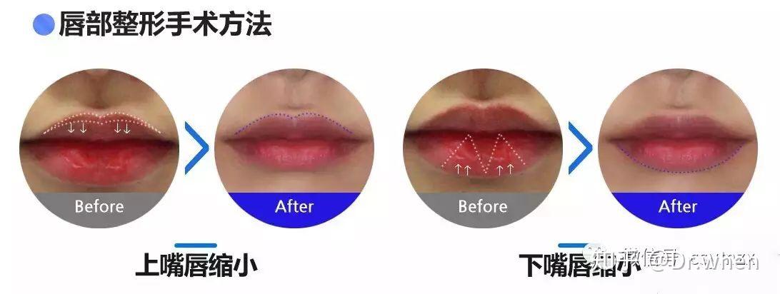 M唇手术详情 - 知乎