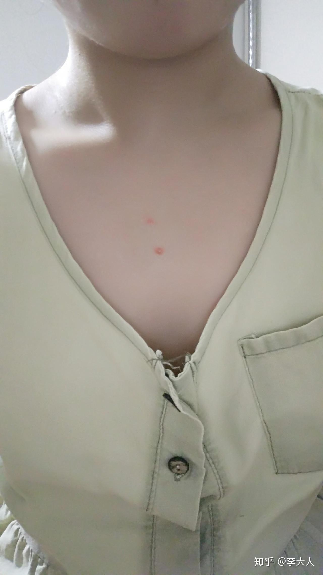 胸前长了一颗像痘一样的东西,有六年了 不痛不痒的 硬硬的.